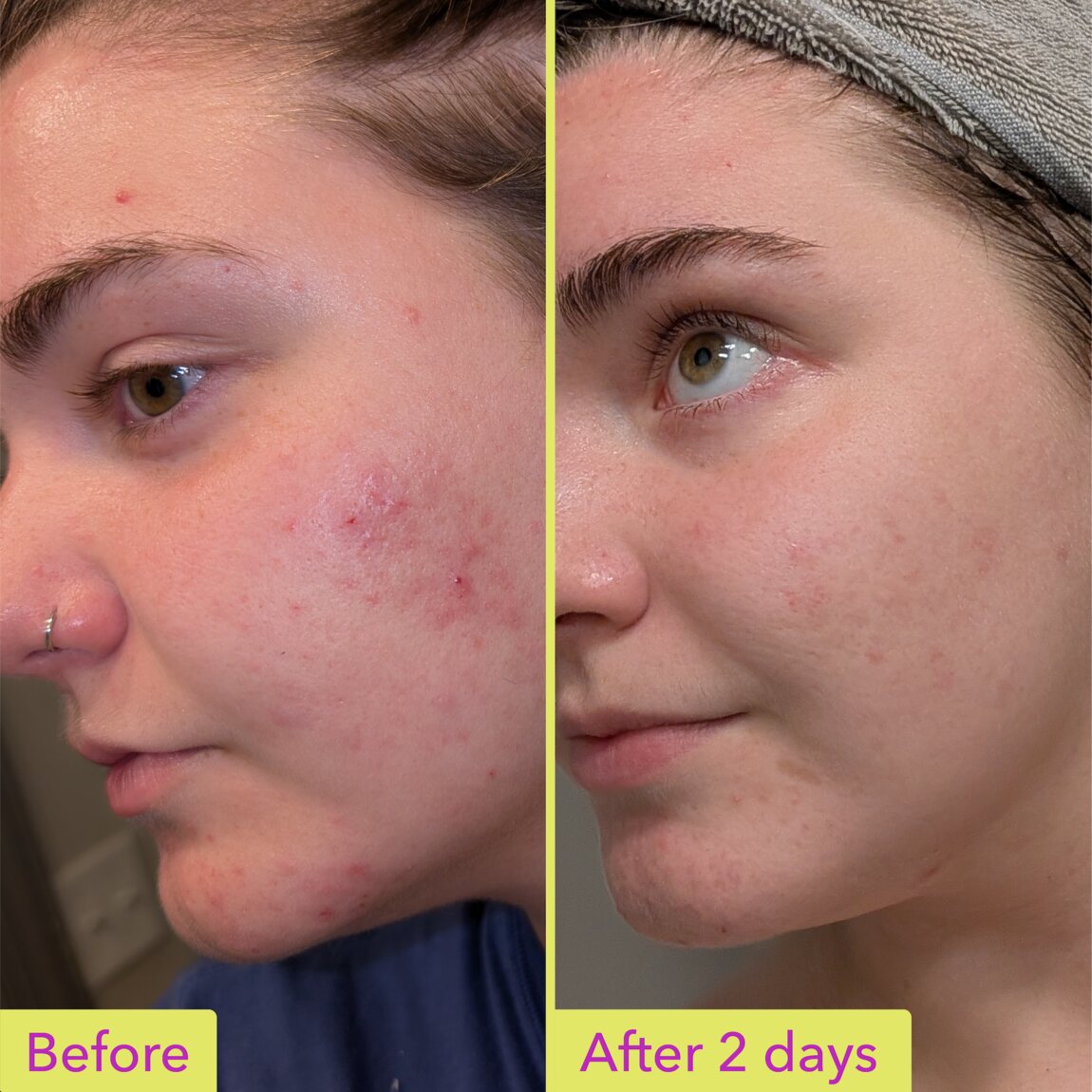 10-azelaic-acid-treatment-z0 zb_p.jpg