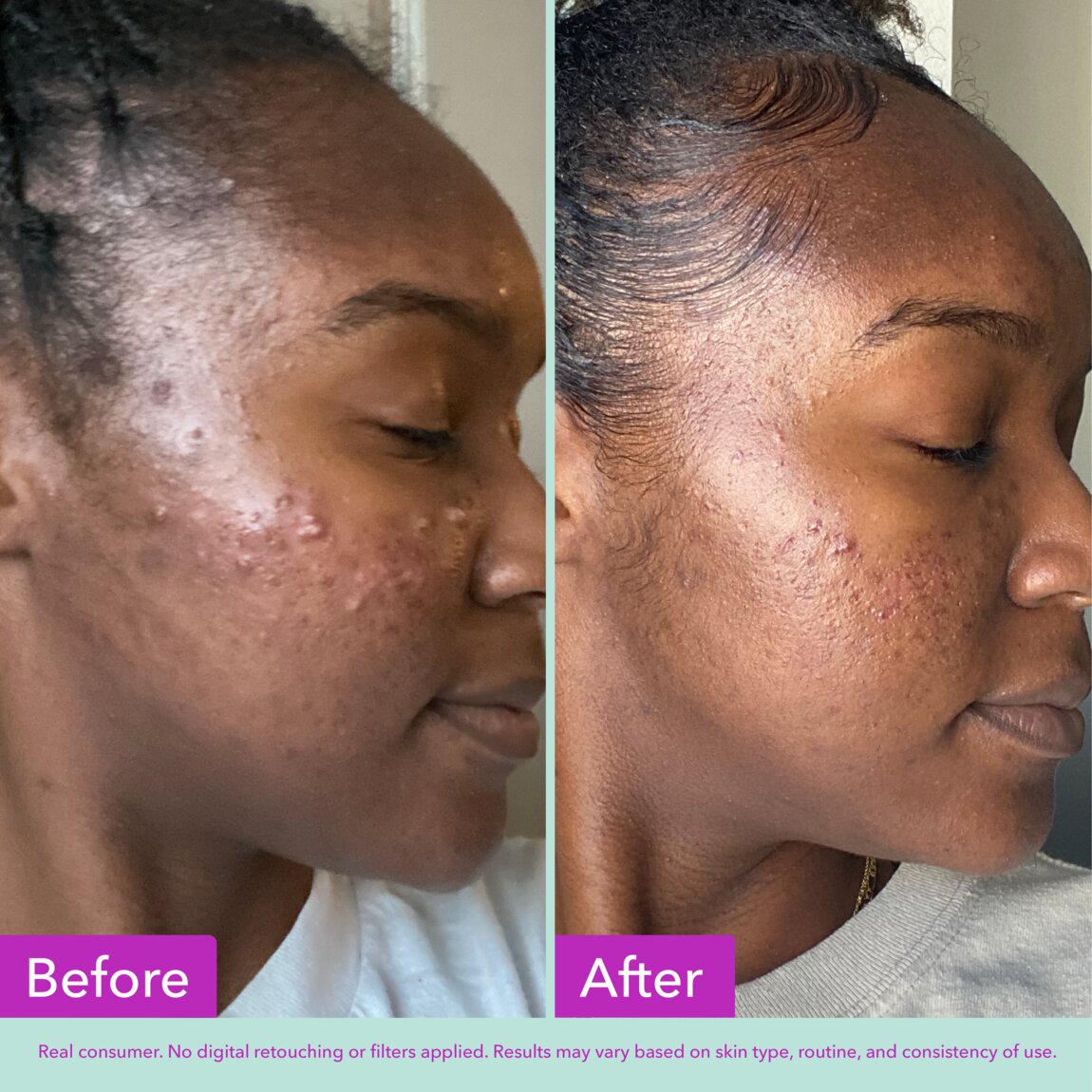 acne-foaming-cleanser-n6 zb_p.jpg